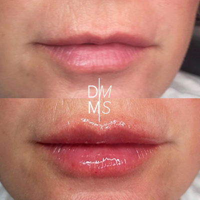Juvederm Lip Injections