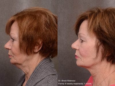 Forma Face Neck 6 treatments
